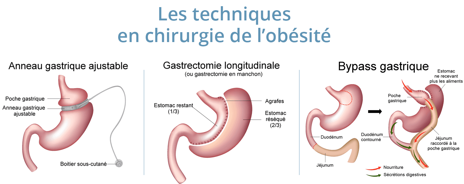 technique-chirurgie-obesite-copaix