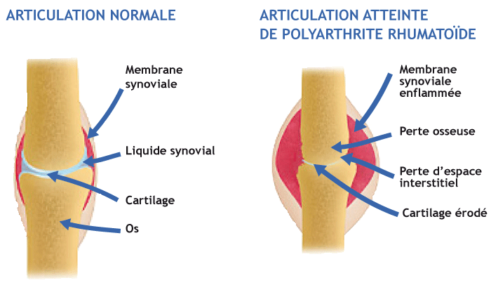 Mains-polyarthrite-rhumatoide-illustration