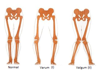 causes-arthrose