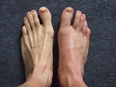 gout-foot2