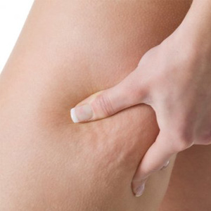 La cellulite peut être dangereuse pour la santé